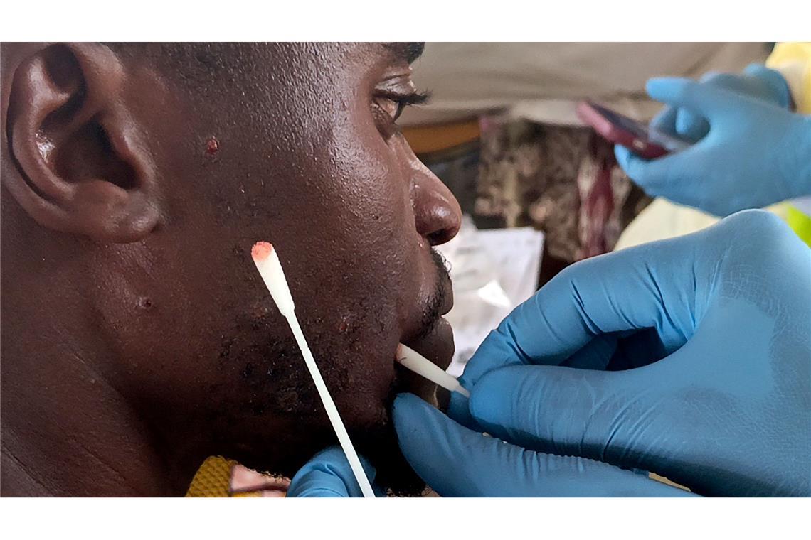 Experten-Warnung: Mpox könnte zu ernster Bedrohung werden Anders als die Pocken lassen sich Mpox nicht ganz ausrotten. (Archivbild)