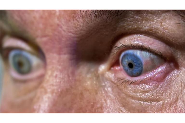 Beschwerden am Auge? Nicht immer ist es der Worst Case (Symbolbild).