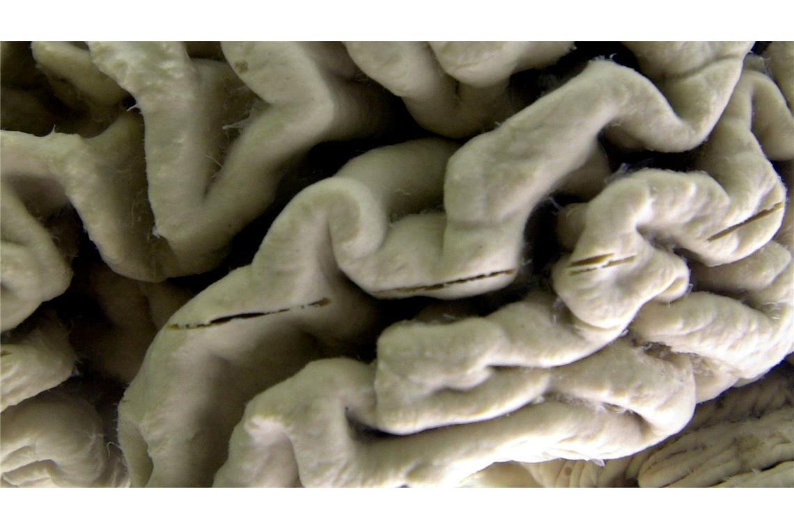 Das Gehirn eines Alzheimer-Patienten zeigt tiefe Furchen. (Illustration)