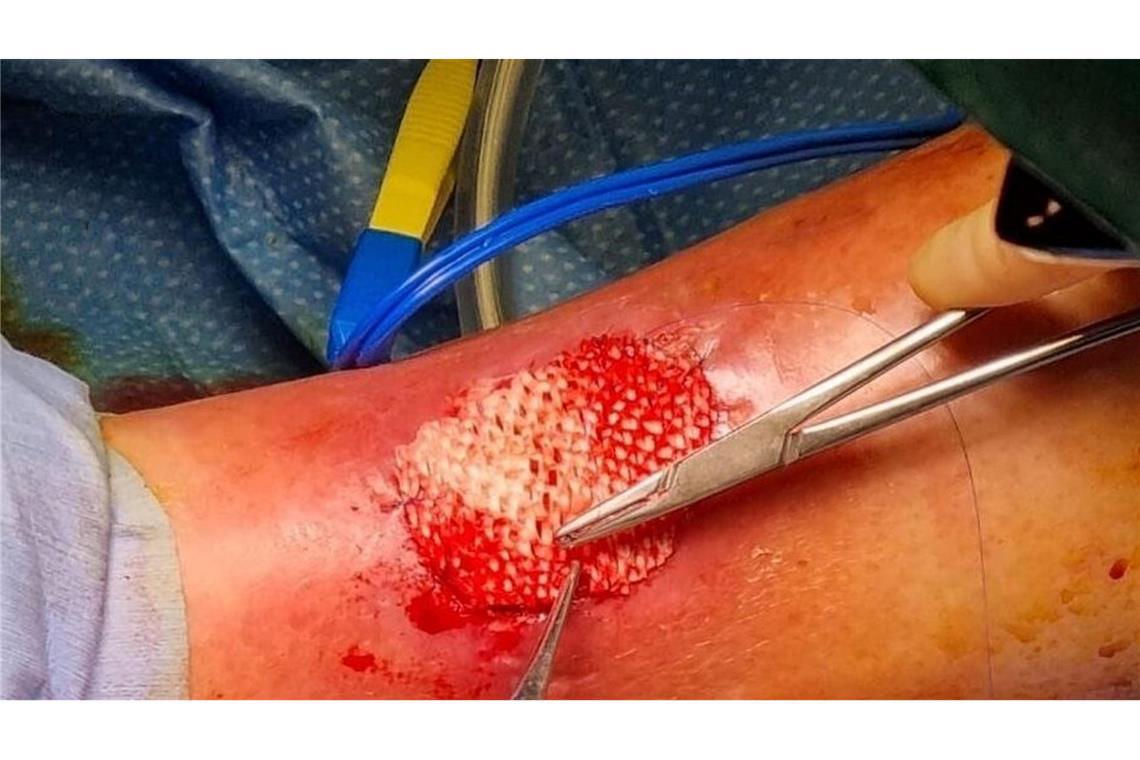 Das Omega-3 in der Fischhaut fördert die Heilung großer Wunden.