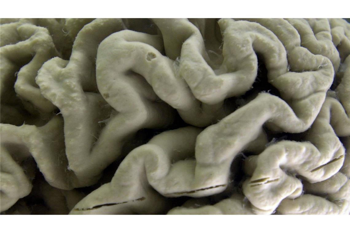Was ist Lecanemab und wie wirkt es? Der Antikörper Lecanemab richtet sich gegen Amyloid-Ablagerungen im Gehirn und soll dadurch den Verlauf der Krankheit in einem frühen Stadium verlangsamen.