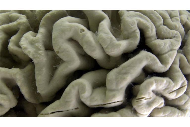 Der Antikörper Lecanemab richtet sich gegen Amyloid-Ablagerungen im Gehirn und soll dadurch den Verlauf der Krankheit in einem frühen Stadium verlangsamen.