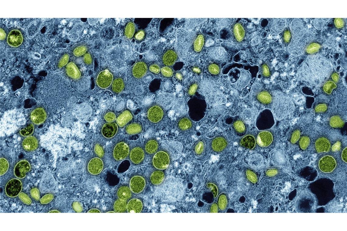Kreis: Bislang keine weiteren Fälle von Mpox bekannt Der erste Fall der Mpox-Variante 1b in Deutschland war Mitte Oktober in Köln bei einem Mann nachgewiesen worden.