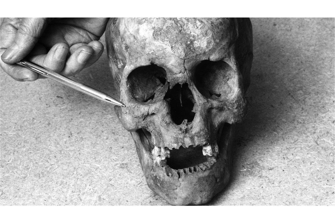 Dieser bei archäologischen Grabungen im schwedischen Lund gefundene historische Schädel zeigt die Folgen vom Syphilis am deformierten rechten Wangenknochen.