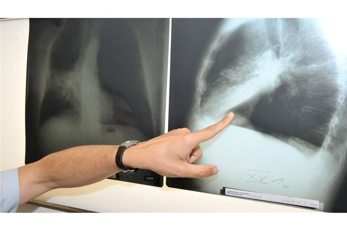Ein Arzt zeigt auf ein Röntgenbild einer von Krebs befallenen Lunge.