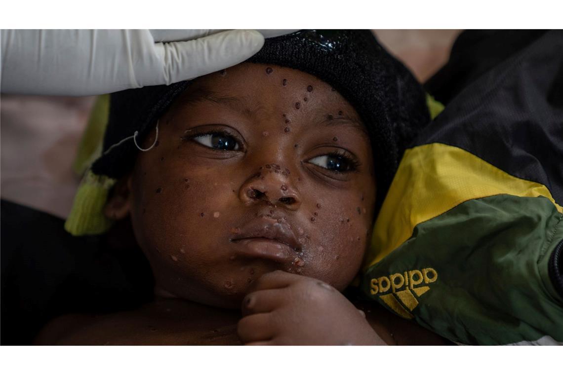 Experten-Warnung: Mpox könnte zu ernster Bedrohung werden Ein besorgniserregendes Risiko sehen die beiden Experten für Übertragungen zwischen Kindern. (Archivbild)