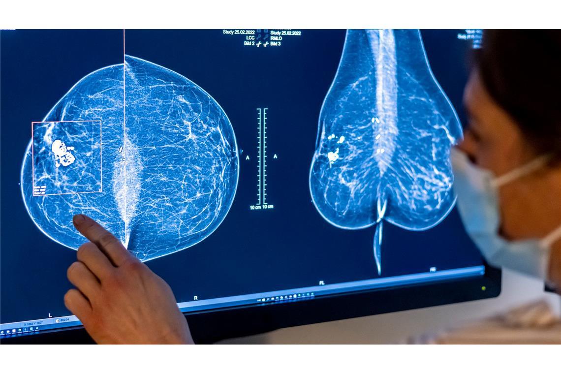 Globale Studie: Vier von zehn Krebstodesfällen vermeidbar Für Frauen gibt es eine spezielle Untersuchung, um Krebs früh zu entdecken: die Mammografie. (Archivbild)