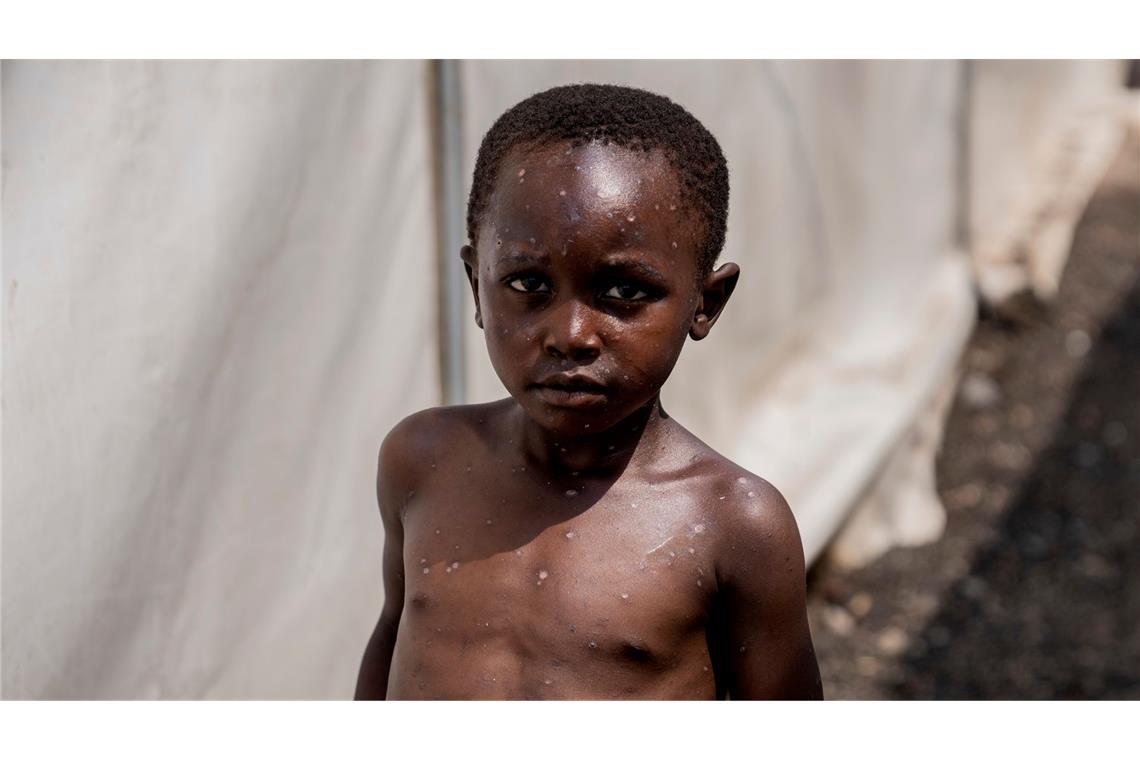 WHO: Mpox-Ausbruch weiter gesundheitliche Notlage Für Kinder und immungeschwächte Menschen kann die Krankheit tödlich sein. (Archivbild)