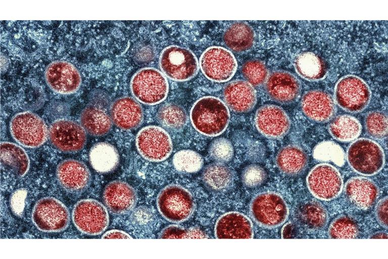 In Berlin wurden viele Mpox-Fälle gemeldet.