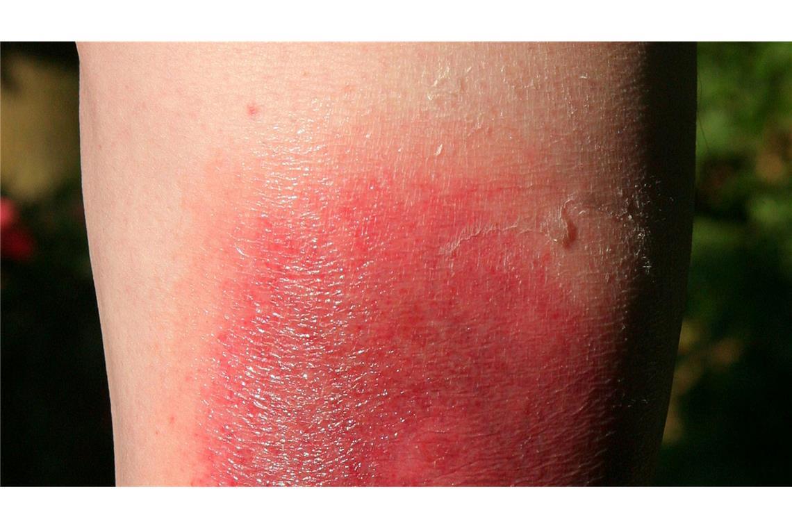 Zecken: "Bedeutendste Überträger von Infektionserregern" Klares Warnzeichen für Borreliose: Die sogenannte Wanderröte kann Tage oder Wochen nach einem Zeckenstich auftreten. (Archivbild)