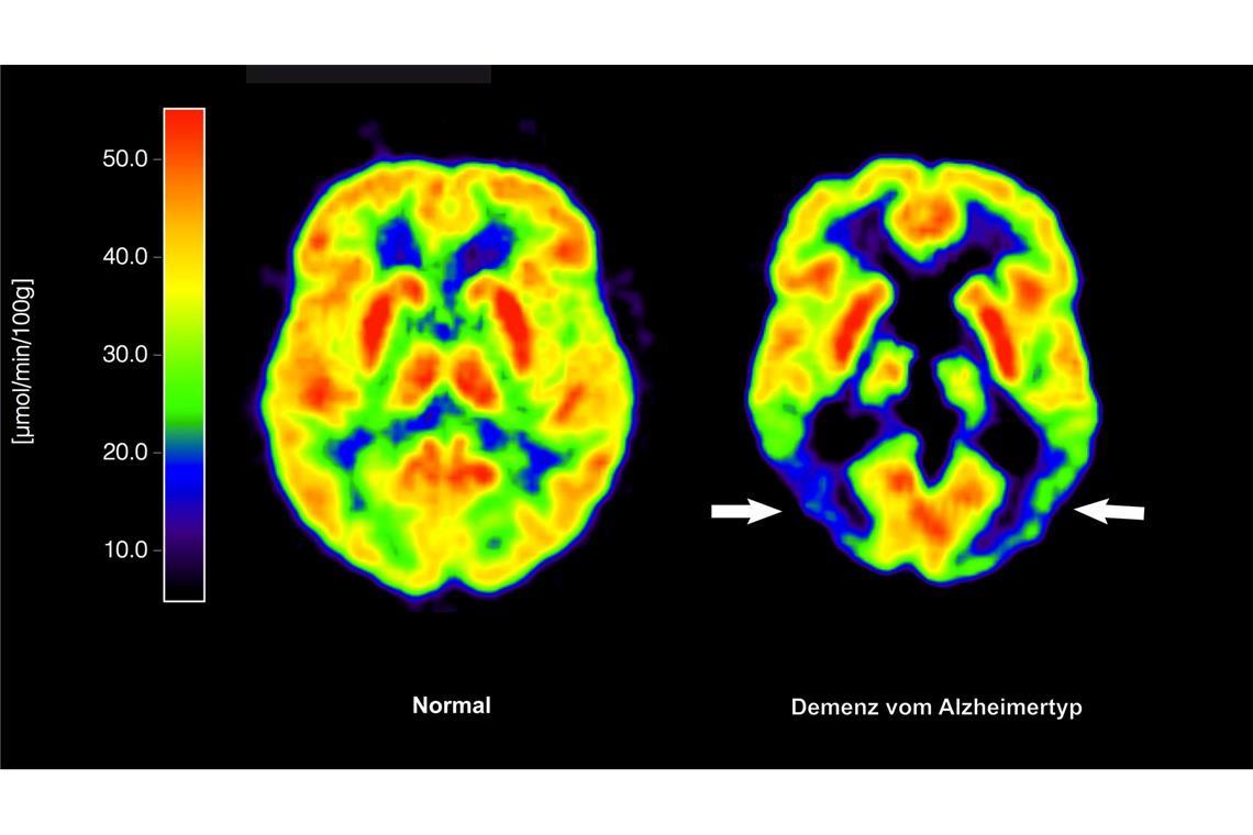 EU-Kommission lässt Wirkstoff Lecanemab gegen Alzheimer zu Lecanemab richtet sich gegen Amyloid-Ablagerungen im Gehirn und soll dadurch den Verlauf der Krankheit ein wenig verlangsamen. (Archivbild)