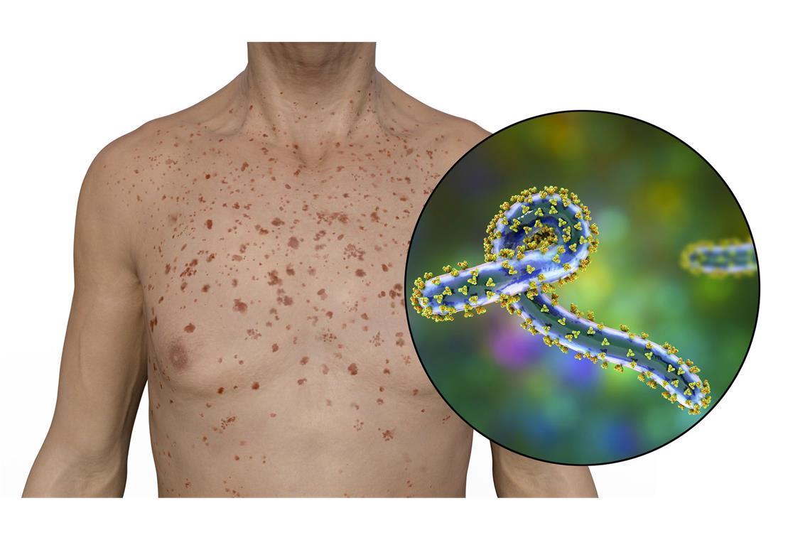 Acht Tote durch Marburg-Virus in Tansania Menschen stecken sich durch direkten engsten Kontakt von Haut oder Schleimhaut sowie direkten Kontakt mit Körperflüssigkeiten Infizierter wie Blut an und nicht über die Luft.