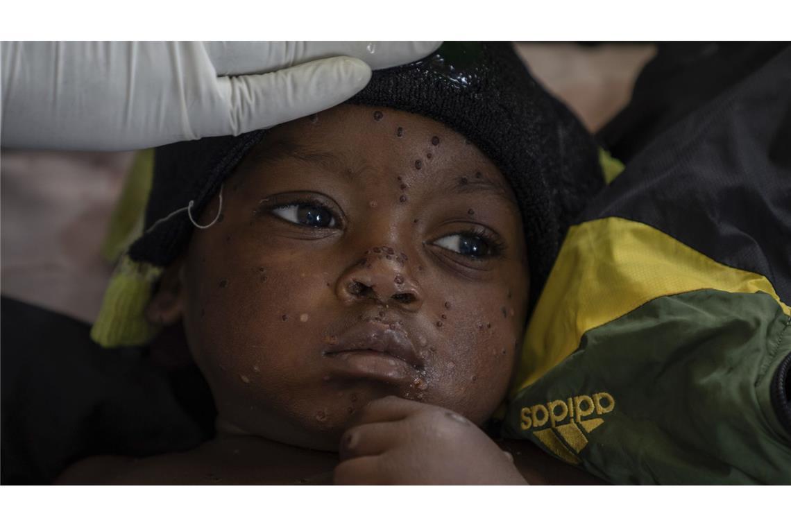 Wie bedrohlich ist das Mpox-Virus? Mpox in Afrika (Bild) – und neuerdings auch in Deutschland.