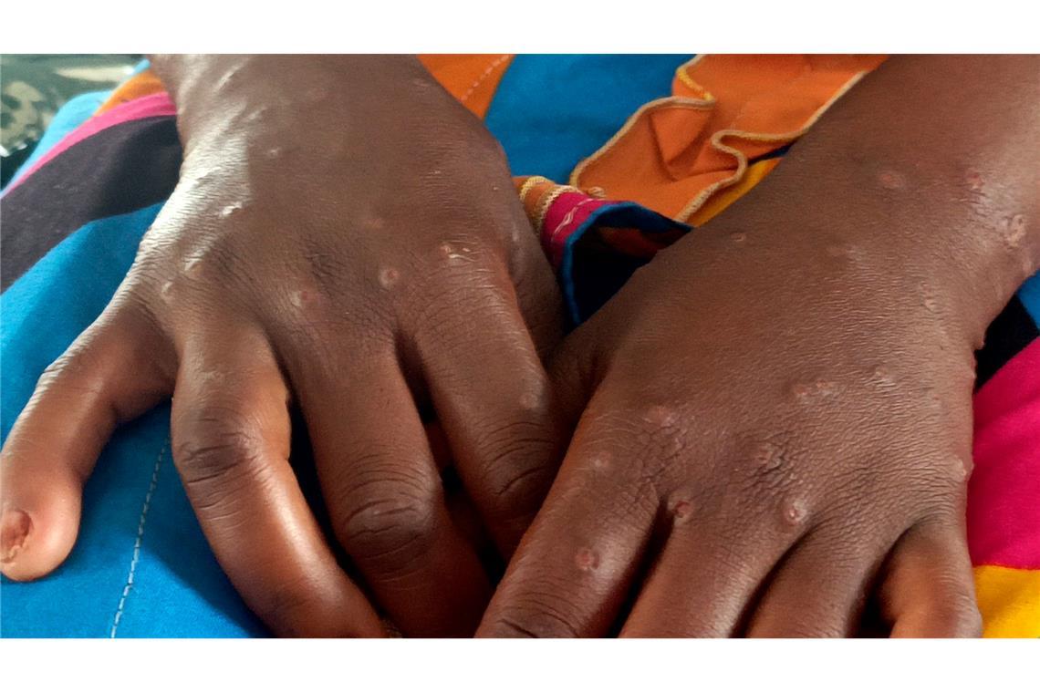 Internationale Notlage wegen Mpox aufgehoben Mpox ist vor allem für kleine Kinder und immungeschwächte Menschen gefährlich (Archivbild)