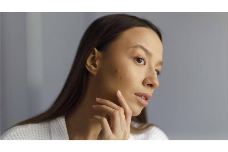 Pickel im Gesicht? Finger weg, auch wenn’s schwerfällt!