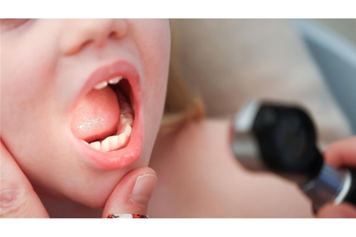 Deutlich mehr Scharlach-Fälle im Südwesten – Experten haben Erklärung Scharlach kommt bei Kindern häufiger vor. (Symbolfoto)
