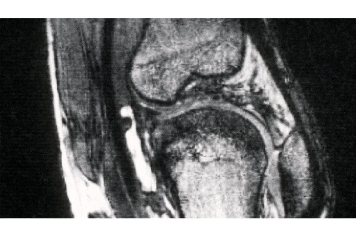 Kassen warnen vor riskanten Hüft- und Kniespritzen Schmerzen im Knie treiben viele Versicherte zum Orthopäden - viele kommen dort mit fragwürdigen Therapien in Kontakt. (Archivbild)