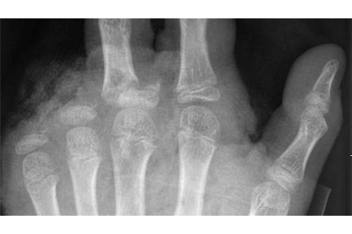 So kann ein Röntgenbild nach einer missglückten Böllerexplosion aussehen: Zwei Finger fehlen.