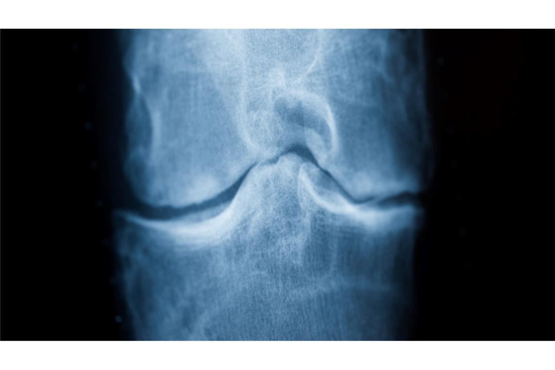 Spätestens das Röntgenbild schafft Klarheit: Der Knorpel nutzt sich immer mehr ab. Im späteren Stadium einer Arthrose reibt Knochen direkt auf Knochen. (Archivbild)