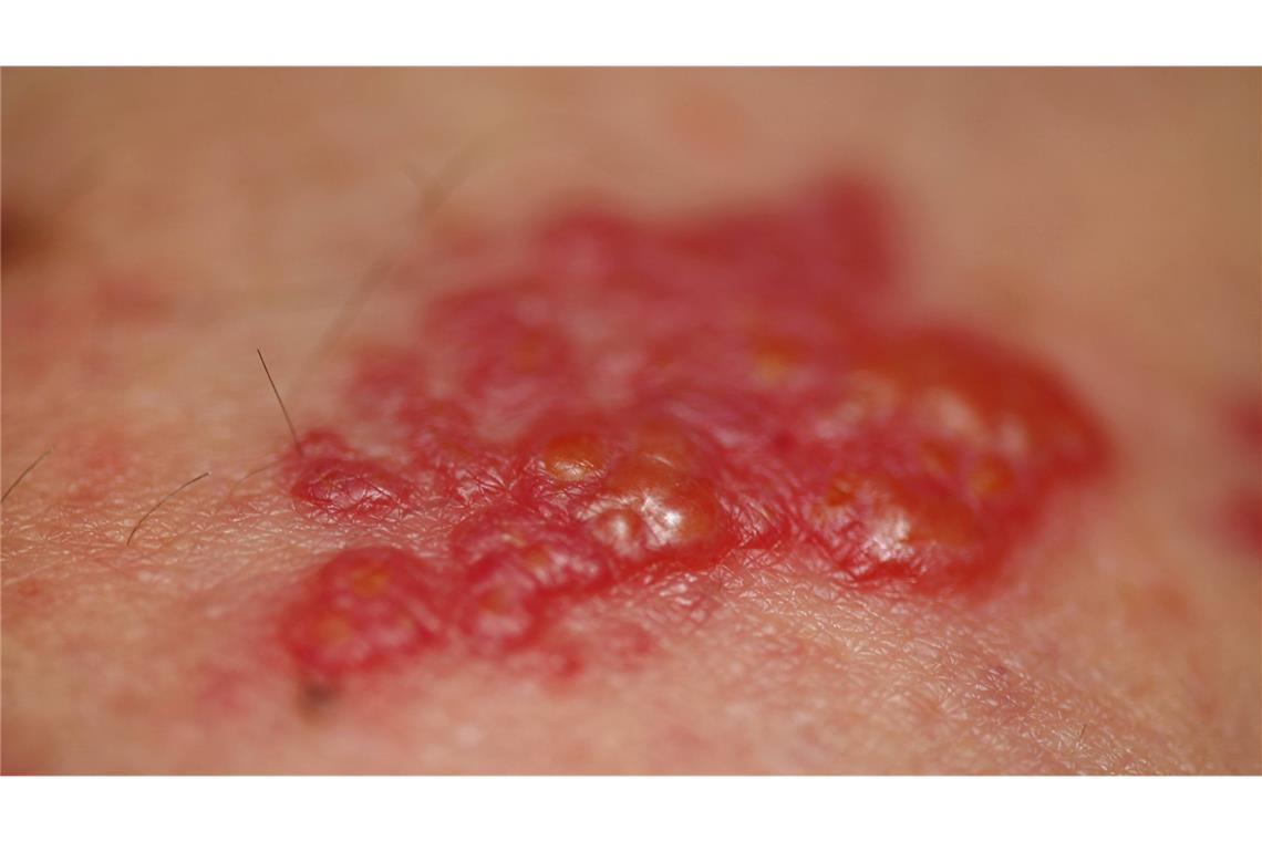 Verdacht auf Gürtelrose: Bei solchen rotgefärbten Bläschen auf der Haut, sollten Sie dringend zum Arzt gehen.