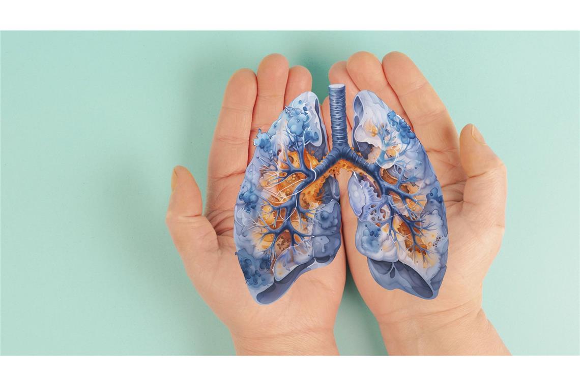 Virale Atemwegsinfektionen wie Grippe oder Covid-19 können gestreute Krebszellen in der Lunge reaktivieren und dadurch die Metastasenbildung fördern.