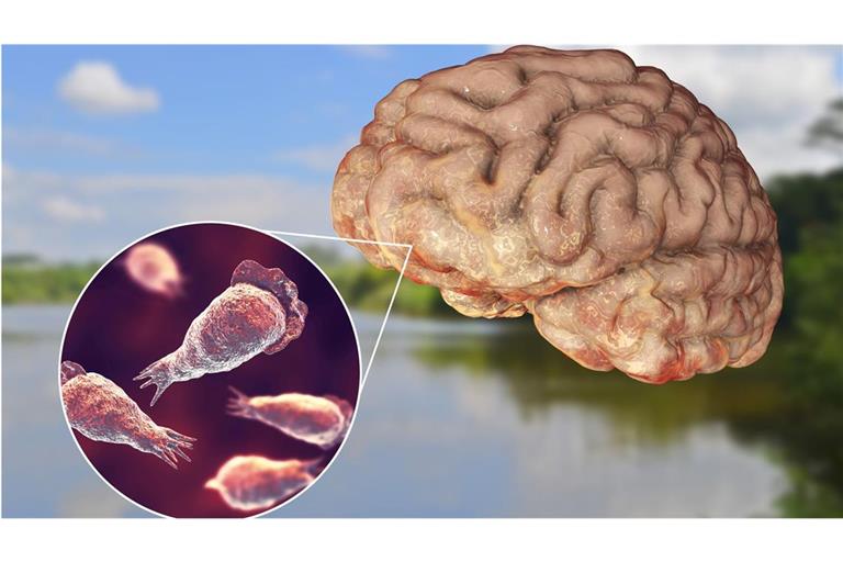 Wenn die Parasiten etwa beim Schwimmen in die Nase eines Menschen gelangen, können sie entlang des Riechnervs ins Gehirn vordringen und dort eine eitrige Hirnhautentzündung hervorrufen.