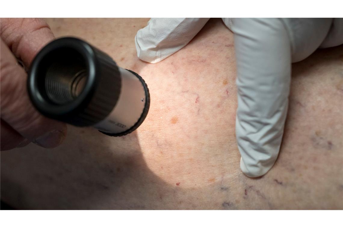 Frühlingswetter: UV-Schutz essenziell für Krebsprävention Wenn ein Muttermal seine Form oder Farbe ändert, sollte das von einem Arzt untersucht werden.